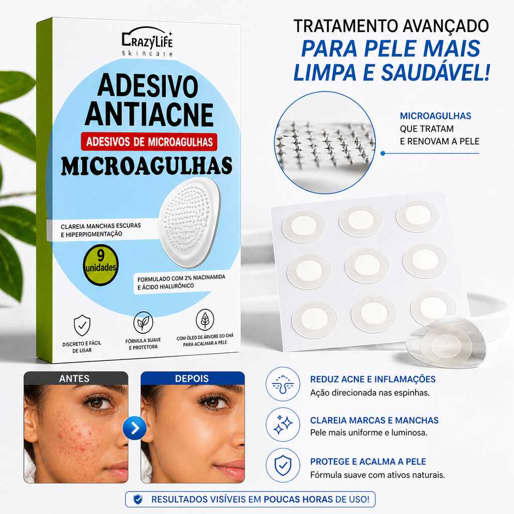 Adesivo Anti Acne com Microagulhas – Resultado Rápido