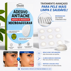 Adesivo Anti Acne com Microagulhas – Resultado Rápido