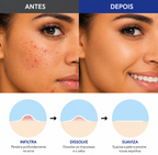 Adesivo Anti Acne com Microagulhas – Resultado Rápido