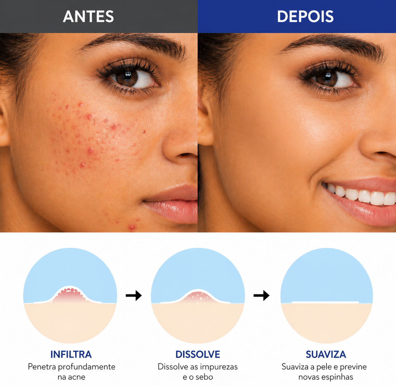 Adesivo Anti Acne com Microagulhas – Resultado Rápido